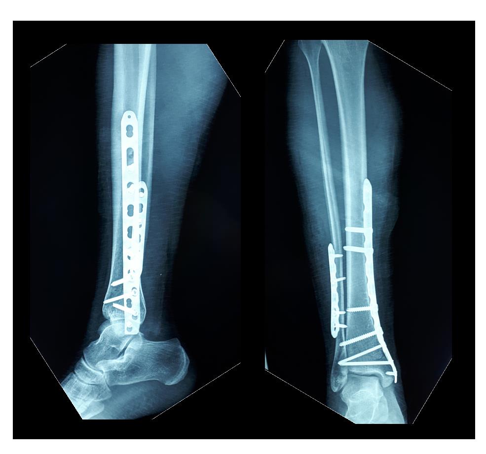 Малоберцовая кость фото на ноге перелом